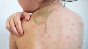 ২৪ ঘন্টায় হামে আরও ৪ শিশুর মৃত্যু